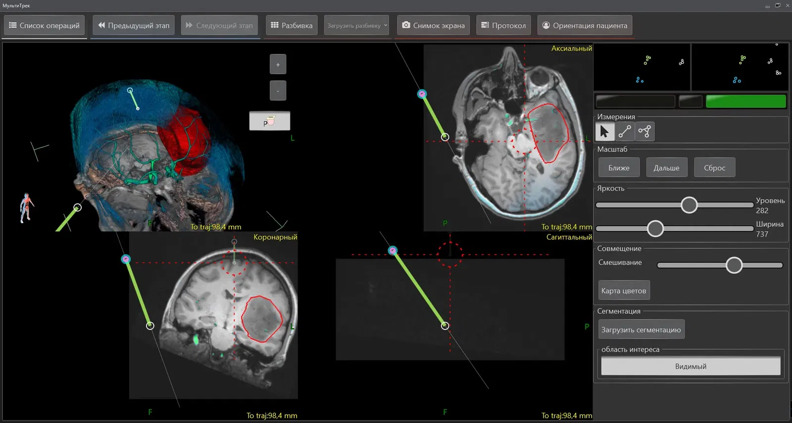 The first Russian optical navigation system for spinal surgeries is being tested at Sechenov University